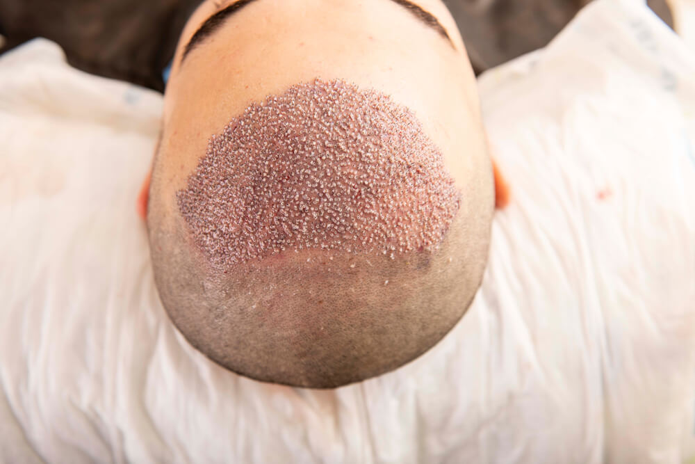 Hair transplant Istanbul for Personalized Hair Design Solutions